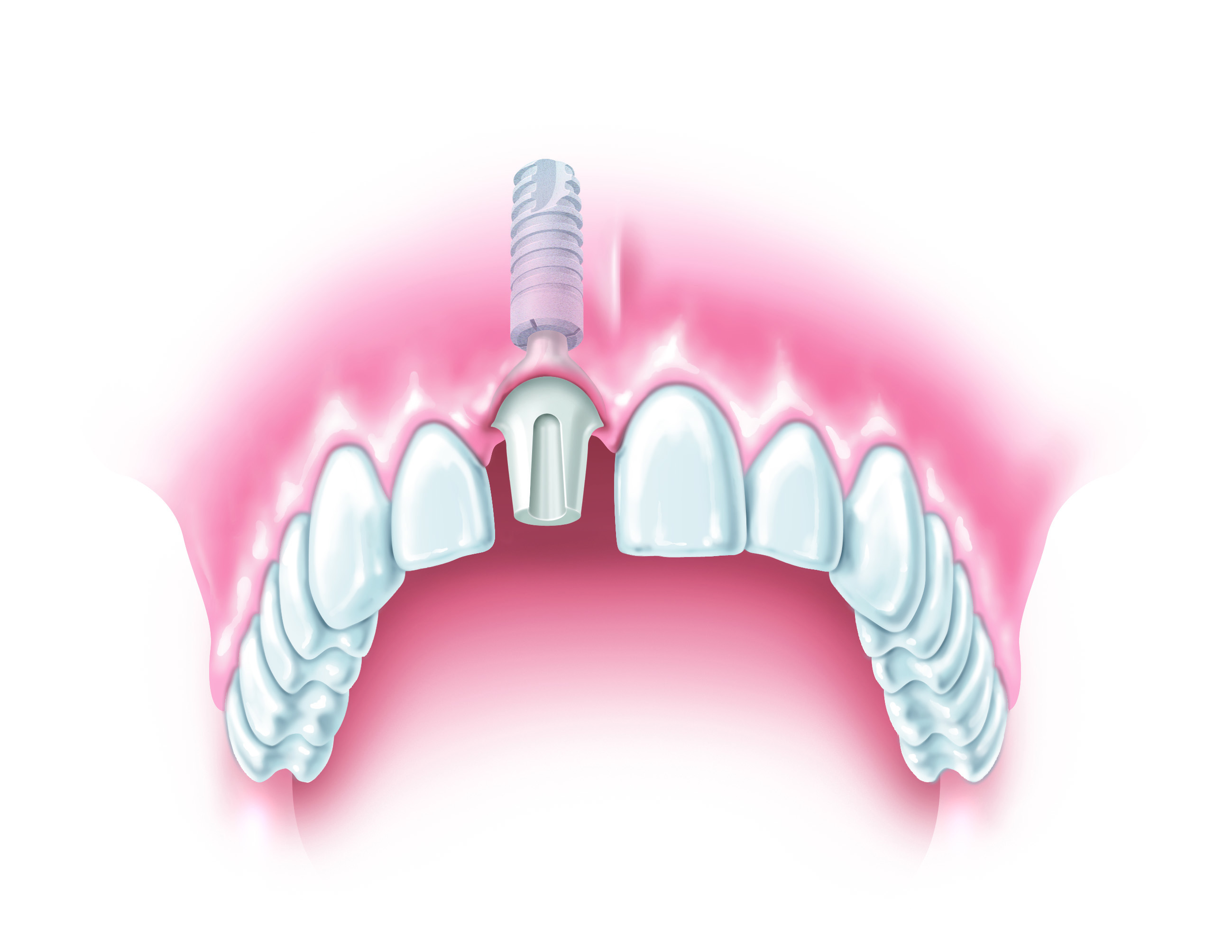 S-tooth-ANKYLOS-b.jpg