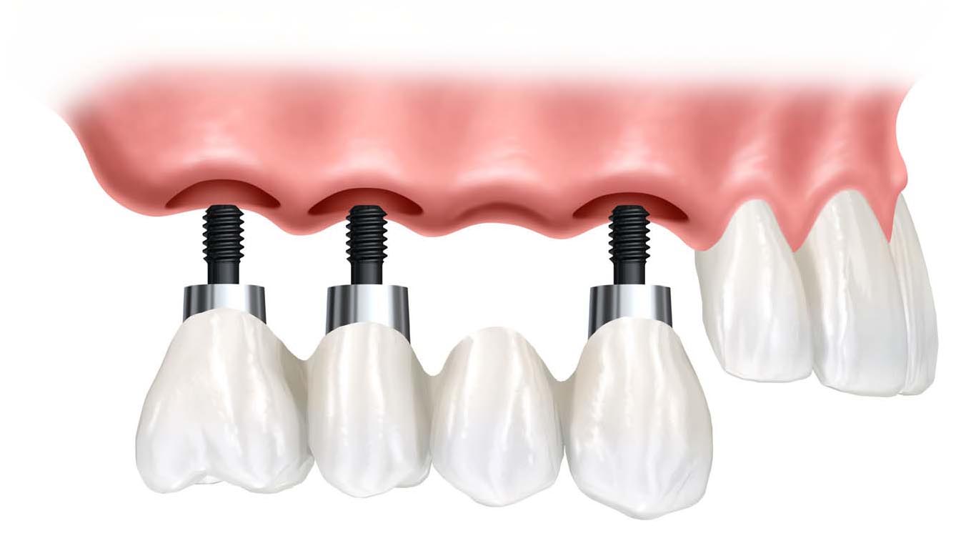 implant-supported-over-denture.jpg
